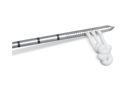 Subchondroplasty® (SCP®) thumbnail 3